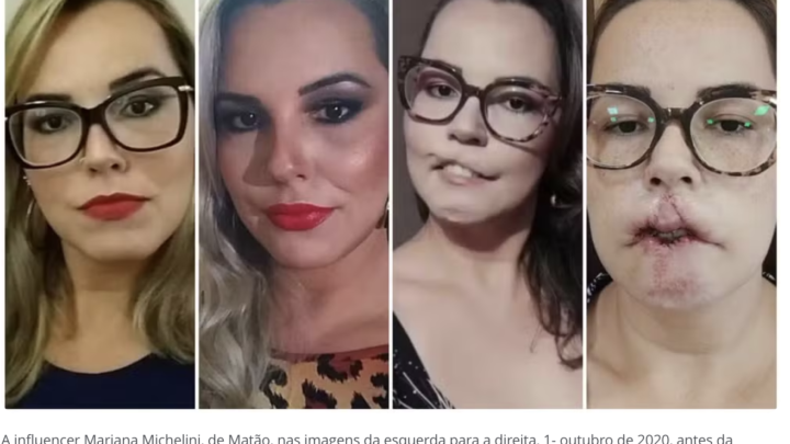 PMMA e os riscos do uso em procedimentos estéticos