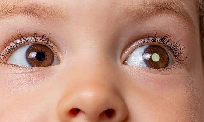 Abrace e HCB promovem campanha de prevenção ao câncer infantil ocular neste sábado (21)